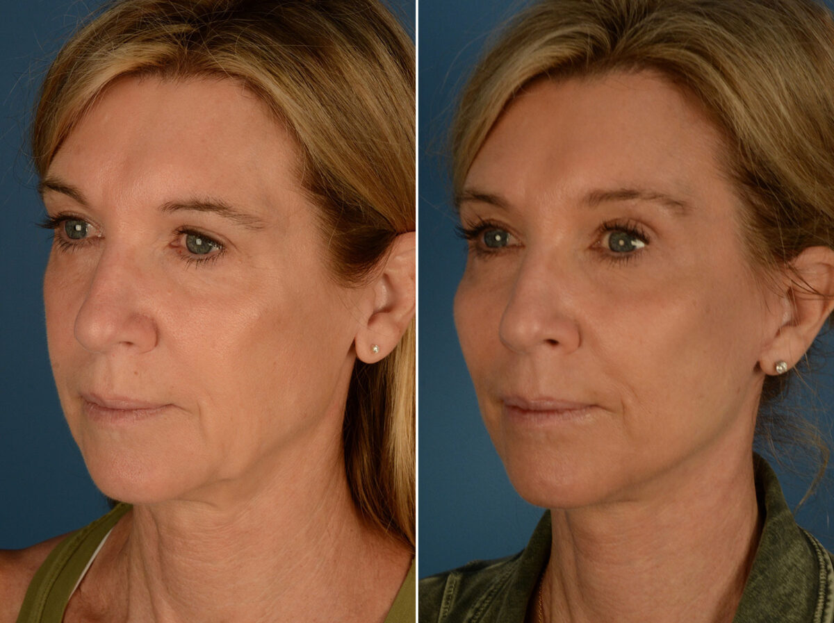 Cheek Implants Before and After Photos in Naples, FL, Patient 25314