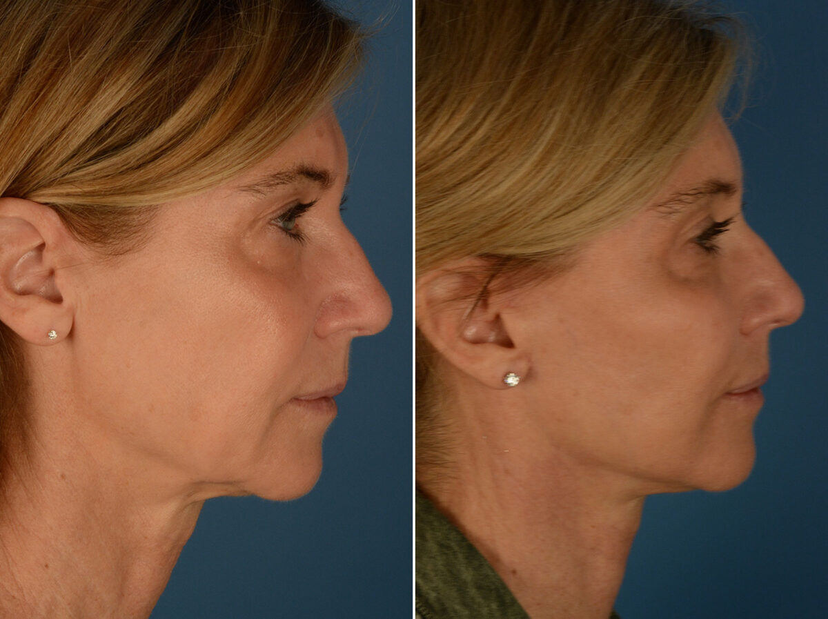 Cheek Implants Before and After Photos in Naples, FL, Patient 25314