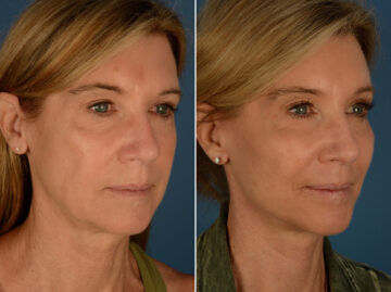Cheek Implants Before and After Photos in Naples, FL, Patient 25314