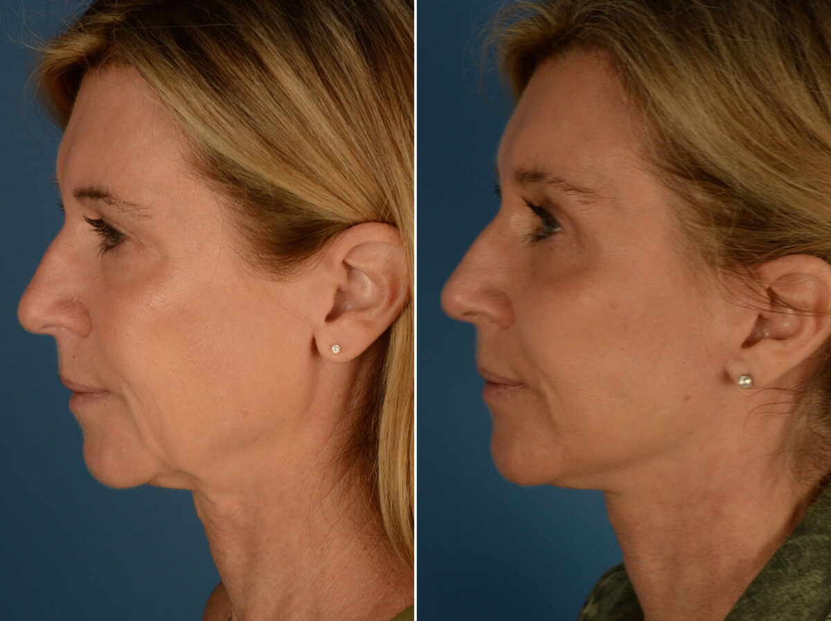 Cheek Implants Before and After Photos in Naples, FL, Patient 25314