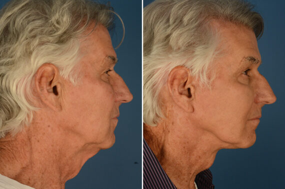 Cheek Implants Before and After Photos in Naples, FL, Patient 23663