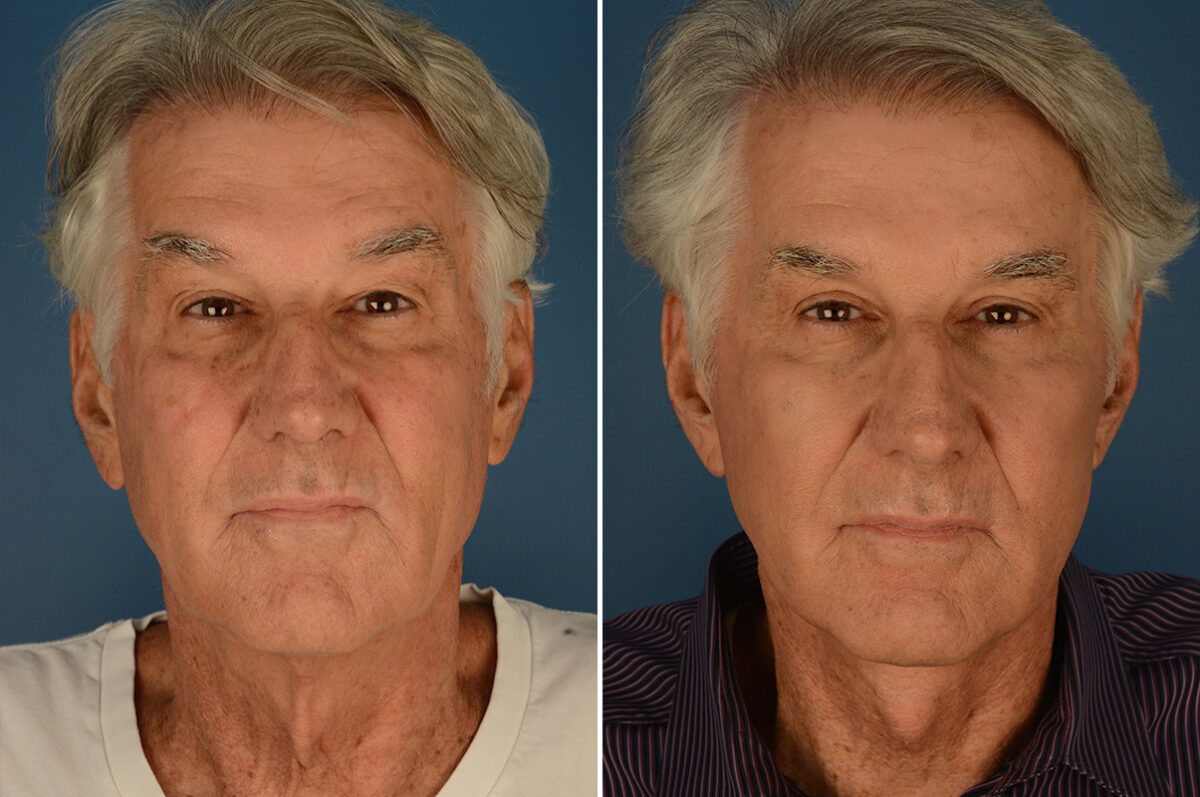 Cheek Implants Before and After Photos in Naples, FL, Patient 23663