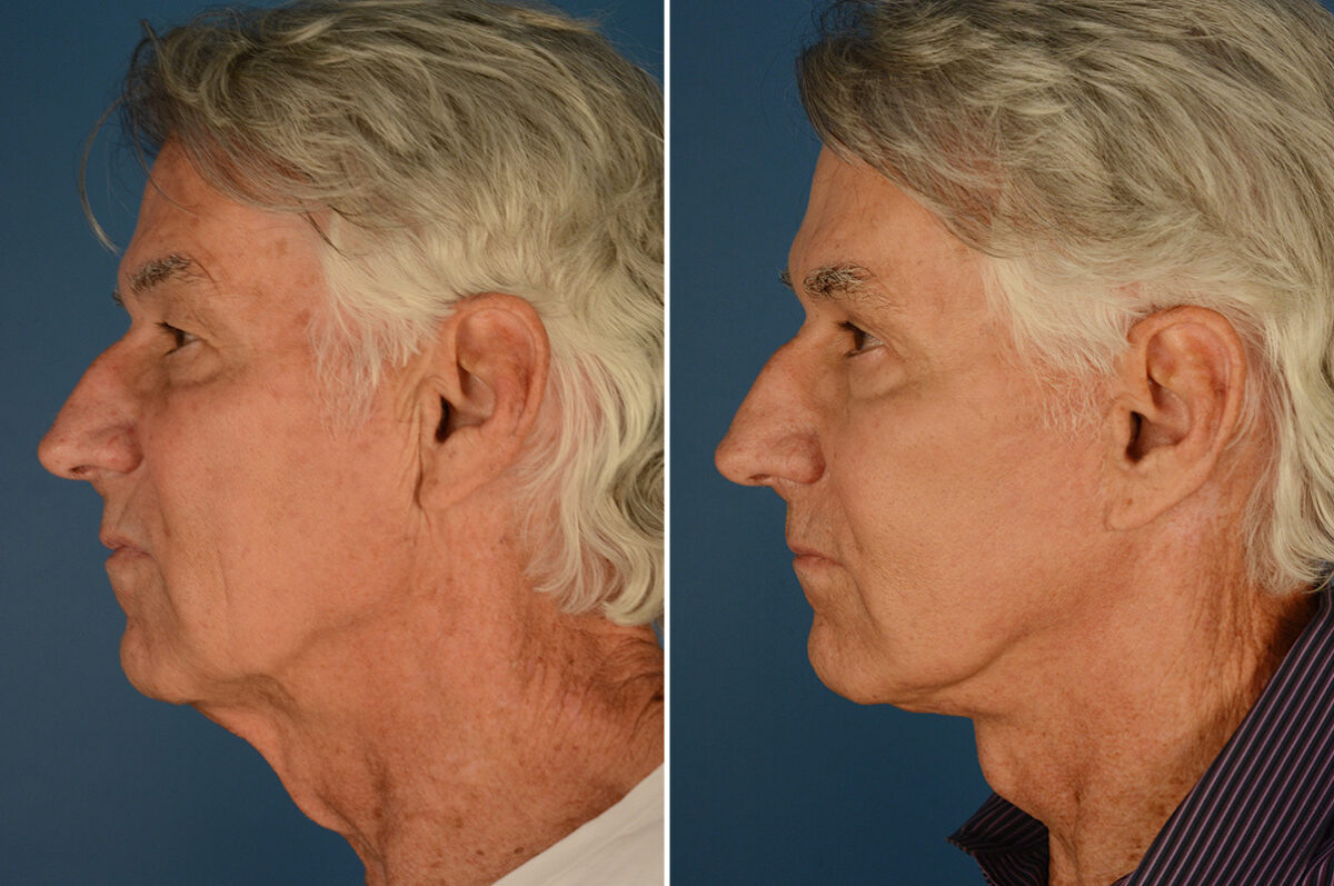 Cheek Implants Before and After Photos in Naples, FL, Patient 23663