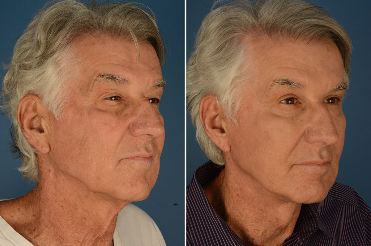 Cheek Implants Before and After Photos in Naples, FL, Patient 23663