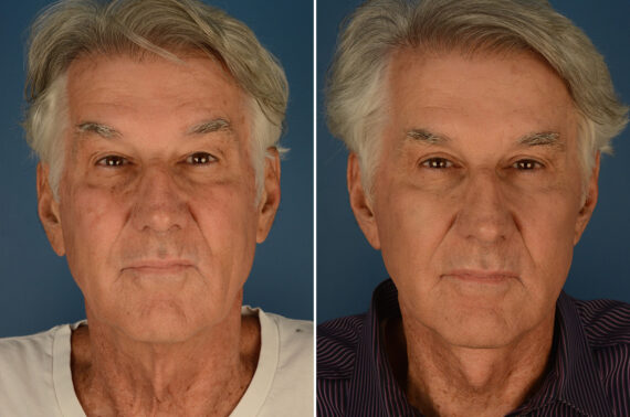 Cheek Implants Male Before and After Photos in Naples, FL, Patient 23663