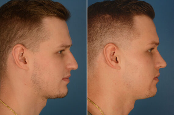 Rhinoplasty Before and After Photos in Naples, FL, Patient 23785