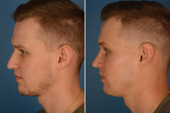 Rhinoplasty Before and After Photos in Naples, FL, Patient 23785