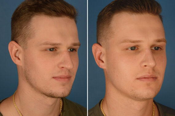 Rhinoplasty Before and After Photos in Naples, FL, Patient 23785