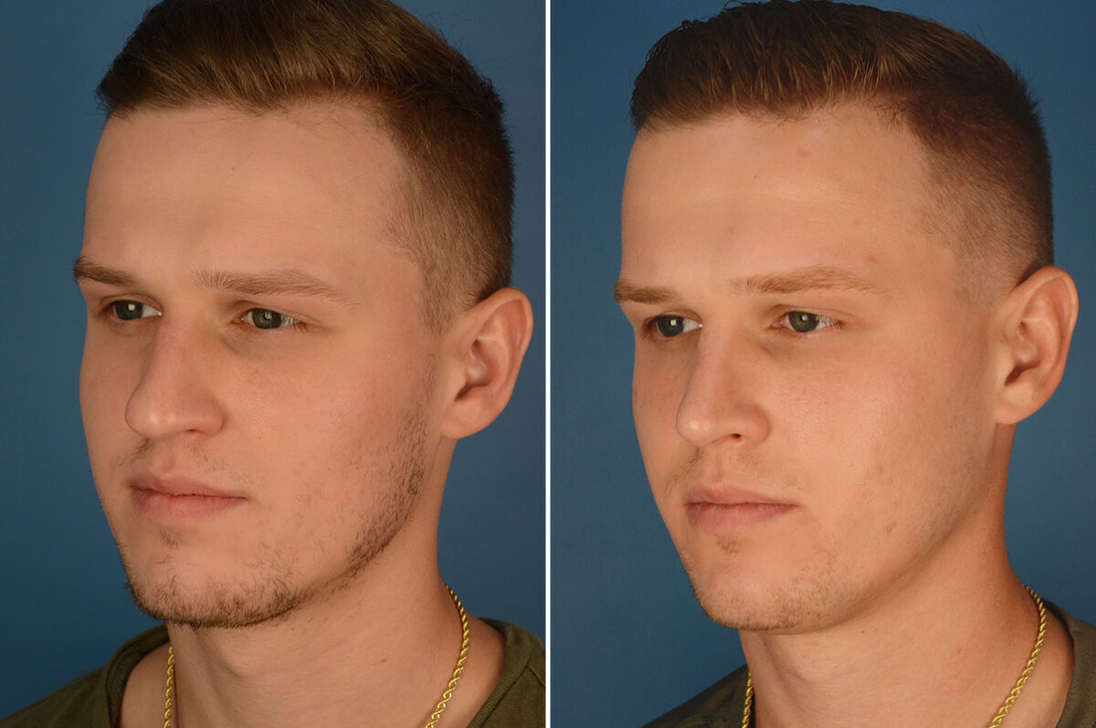 Rhinoplasty Before and After Photos in Naples, FL, Patient 23785