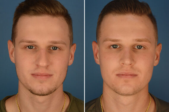 Rhinoplasty Before and After Photos in Naples, FL, Patient 23785