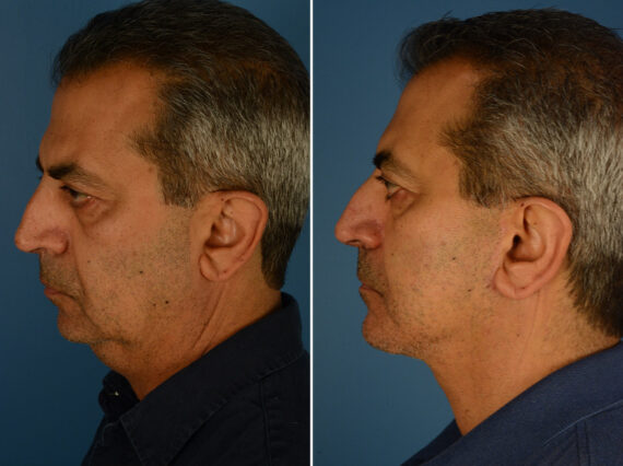 Chin Implant Male Before and After Photos in Naples, FL, Patient 24410