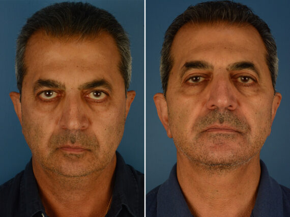 Chin Implant Male Before and After Photos in Naples, FL, Patient 24410