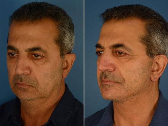 Chin Implant Before and After Photos in Naples, FL, Patient 24410