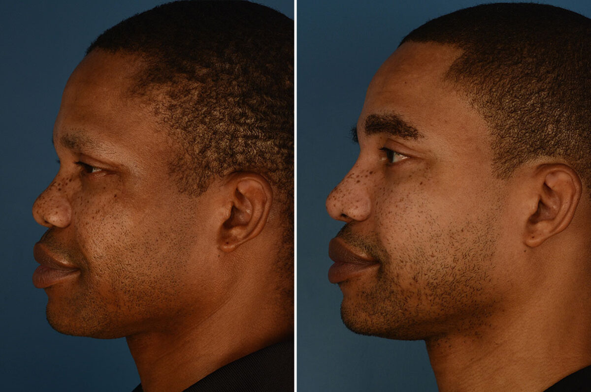 Rhinoplasty Before and After Photos in Naples, FL, Patient 25216