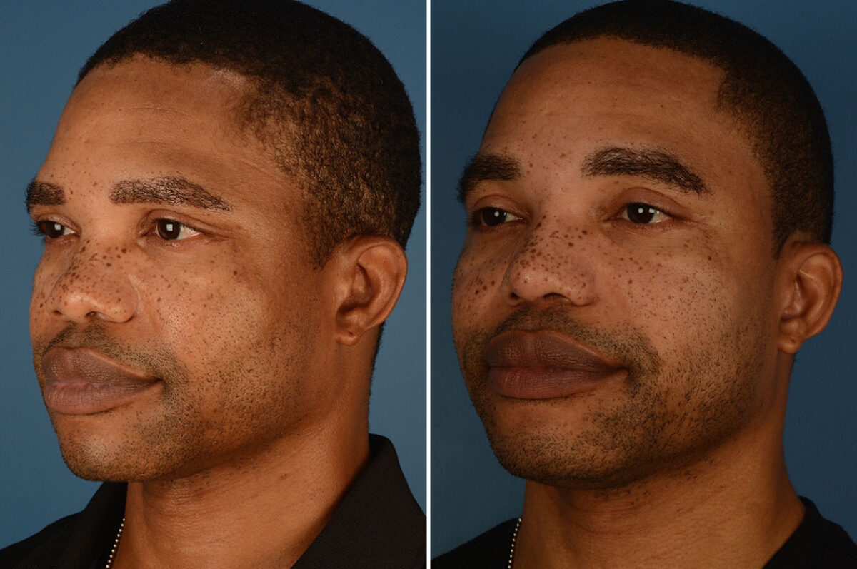 Rhinoplasty Before and After Photos in Naples, FL, Patient 25216