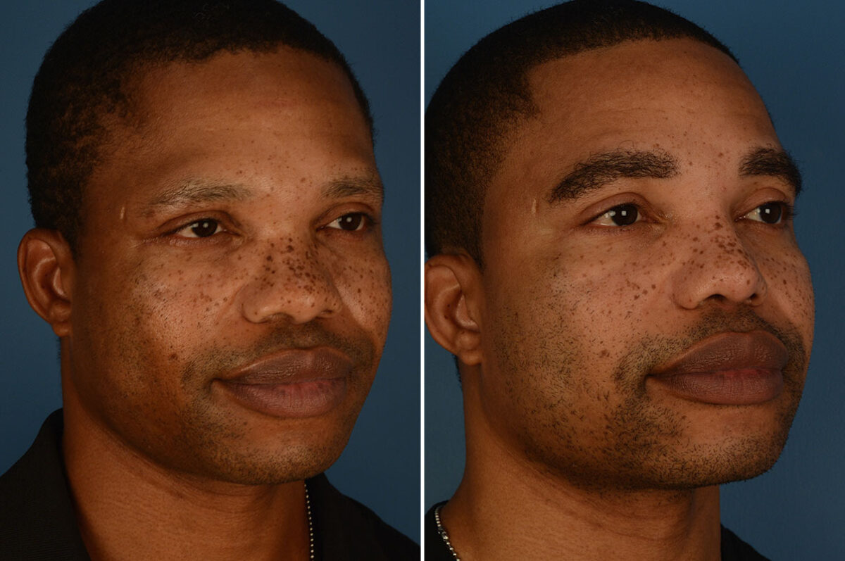 Rhinoplasty Before and After Photos in Naples, FL, Patient 25216