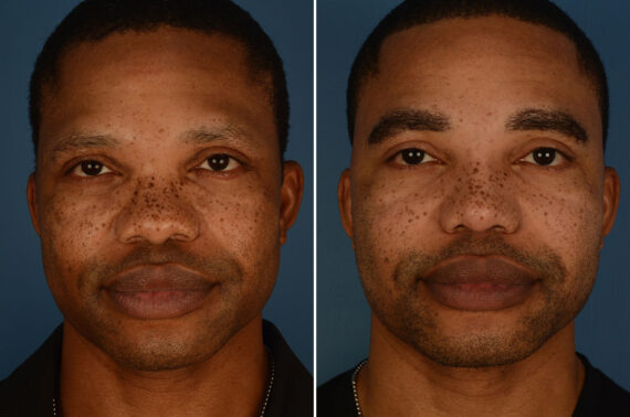 Rhinoplasty Before and After Photos in Naples, FL, Patient 25216