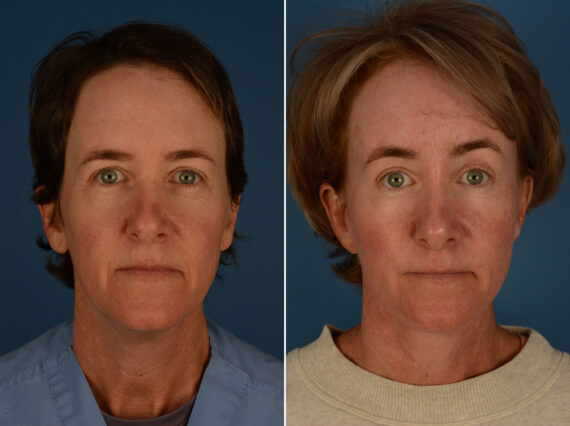 The UpLift™ Lower Face and Neck Lift Before and After Photos in Naples, FL, Patient 25458