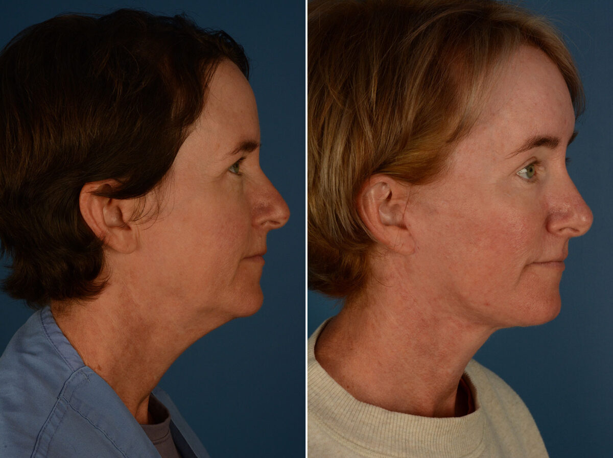 The UpLift™ Lower Face and Neck Lift Before and After Photos in Naples, FL, Patient 25458