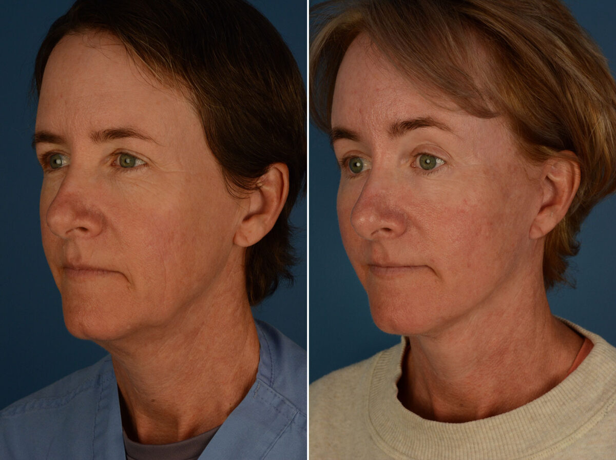 The UpLift™ Lower Face and Neck Lift Before and After Photos in Naples, FL, Patient 25458