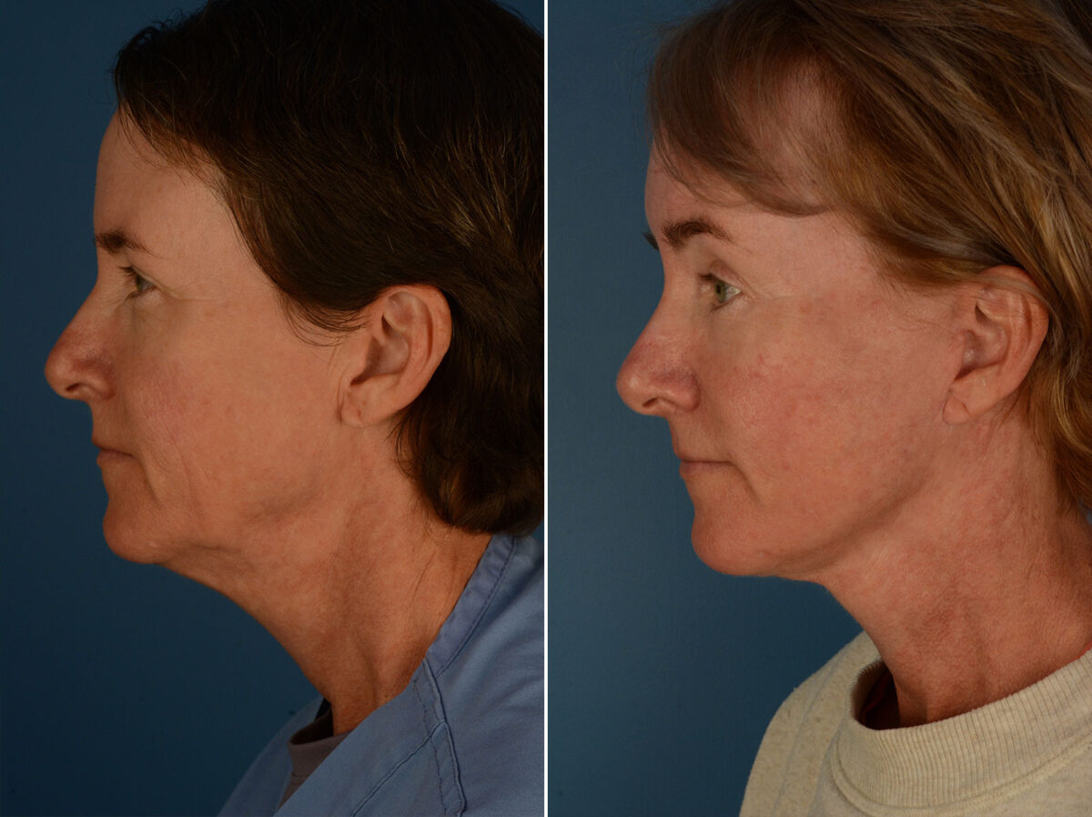 The UpLift™ Lower Face and Neck Lift Before and After Photos in Naples, FL, Patient 25458