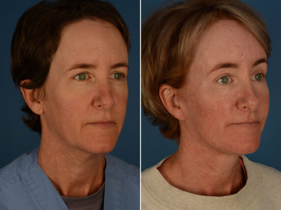 The UpLift™ Lower Face and Neck Lift Before and After Photos in Naples, FL, Patient 25458