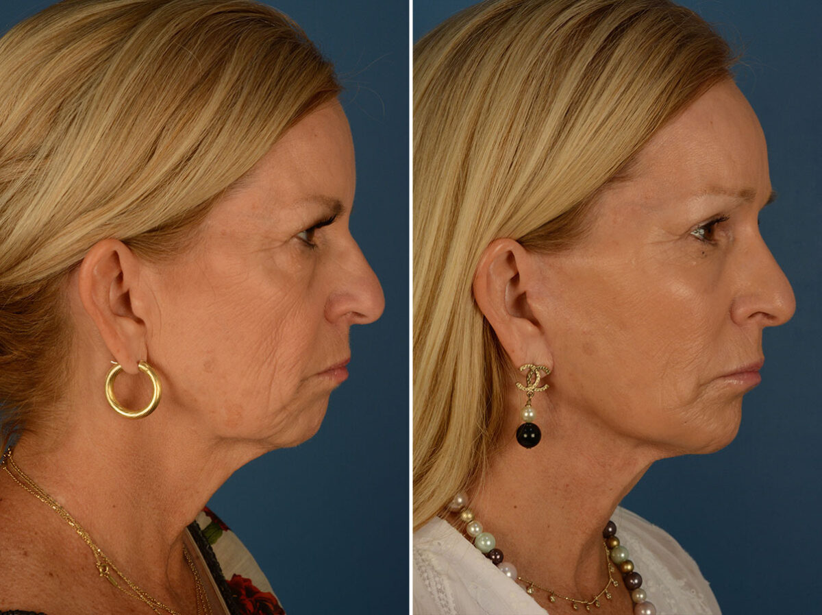 Endoscopic Facelift Before and After Photos in Naples, FL, Patient 25477