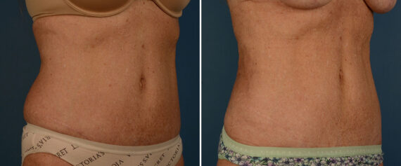 VASER® Liposuction with Renuvion Before and After Photos in Naples, FL, Patient 25740