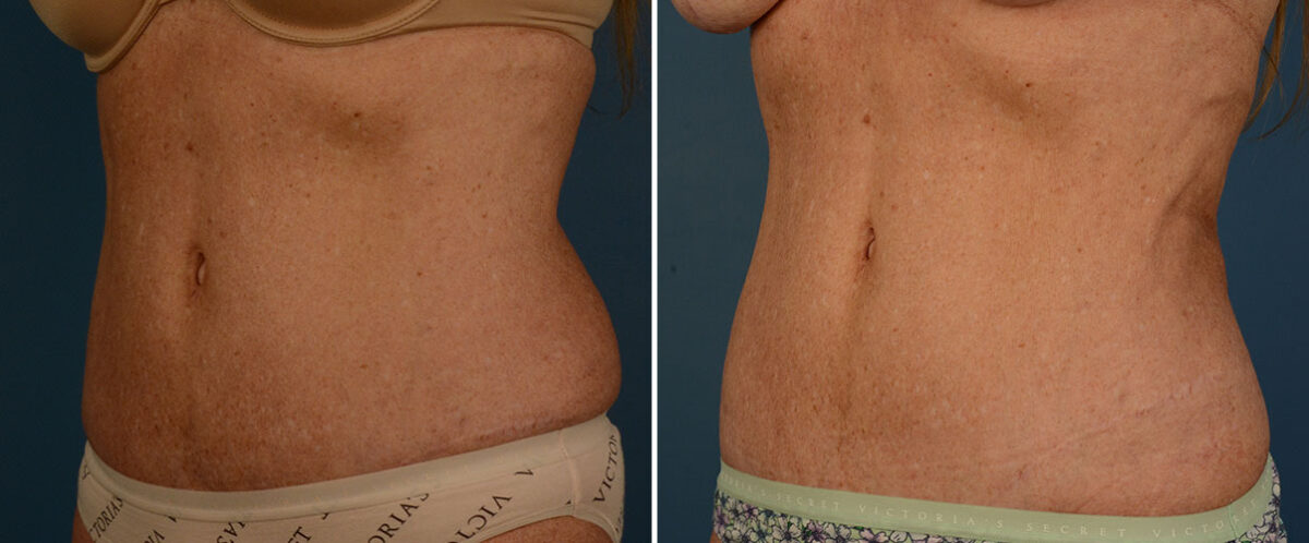 VASER® Liposuction with Renuvion Before and After Photos in Naples, FL, Patient 25740