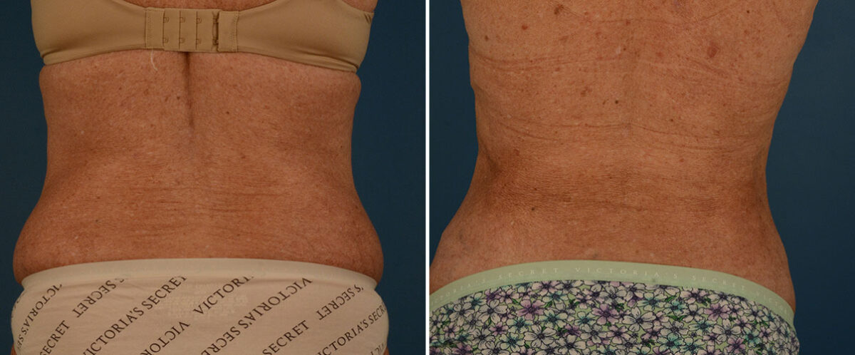 VASER® Liposuction with Renuvion Before and After Photos in Naples, FL, Patient 25740