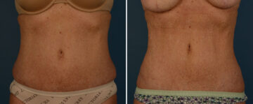 VASER® Liposuction with Renuvion Before and After Photos in Naples, FL, Patient 25740