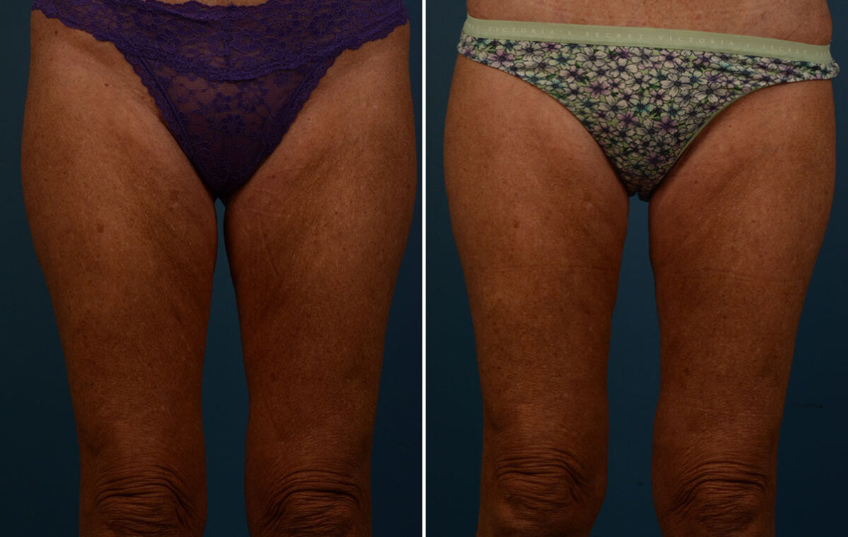 VASER® Liposuction with Renuvion Before and After Photos in Naples, FL, Patient 25740