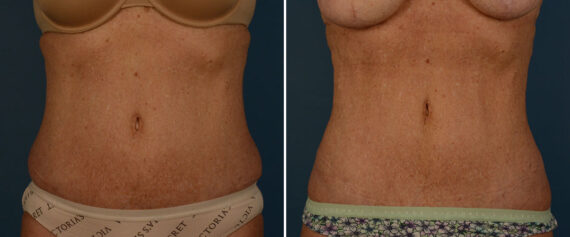 VASER® Liposuction with Renuvion Before and After Photos in Naples, FL, Patient 25740