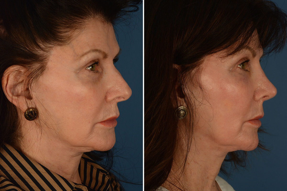 Rhinoplasty Before and After Photos in Naples, FL, Patient 25874