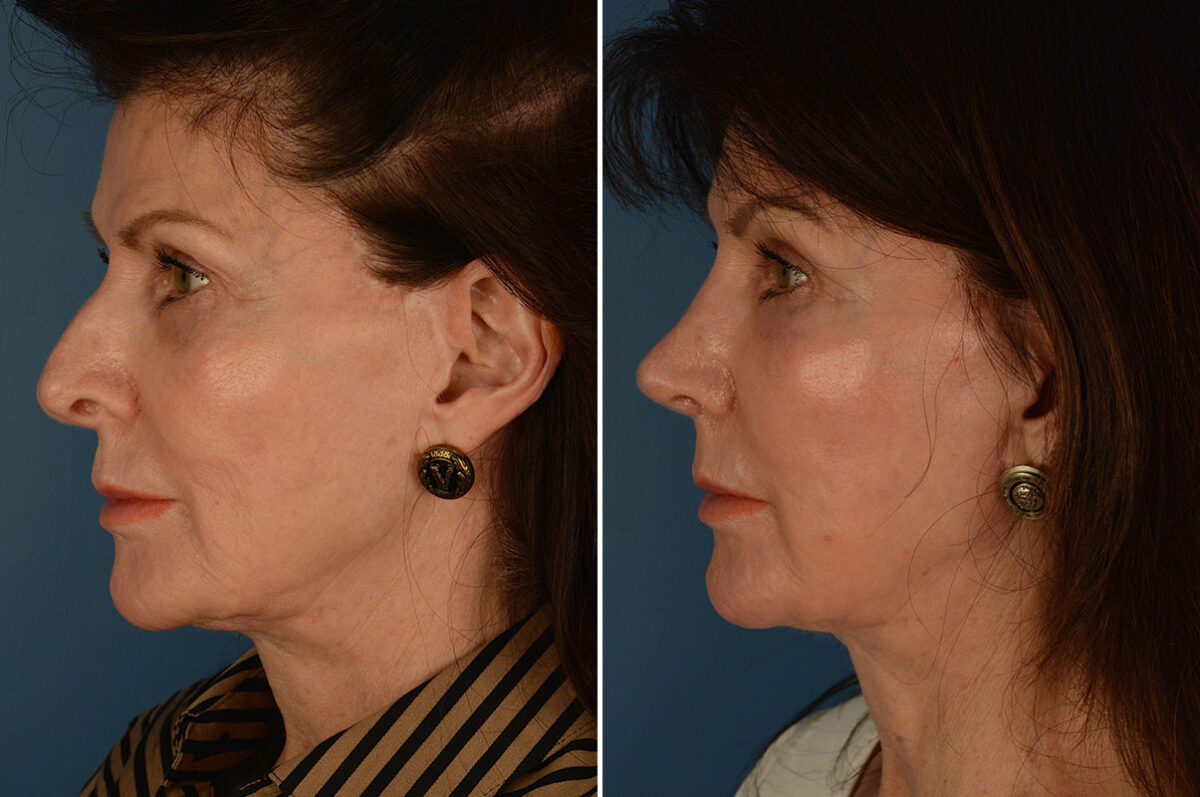 Rhinoplasty Before and After Photos in Naples, FL, Patient 25874