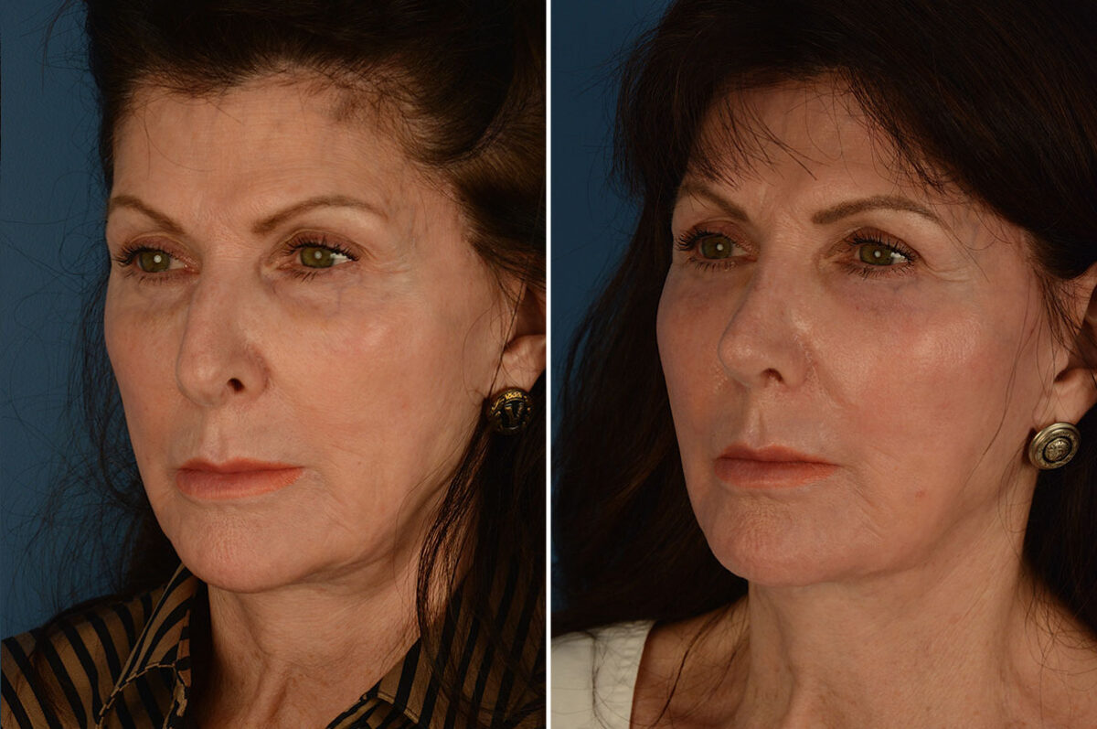 Rhinoplasty Before and After Photos in Naples, FL, Patient 25874
