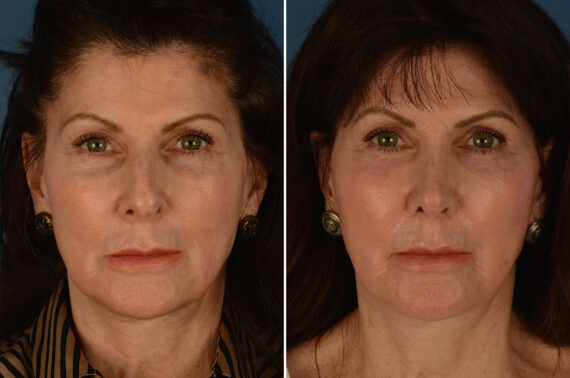 Rhinoplasty Before and After Photos in Naples, FL, Patient 25874