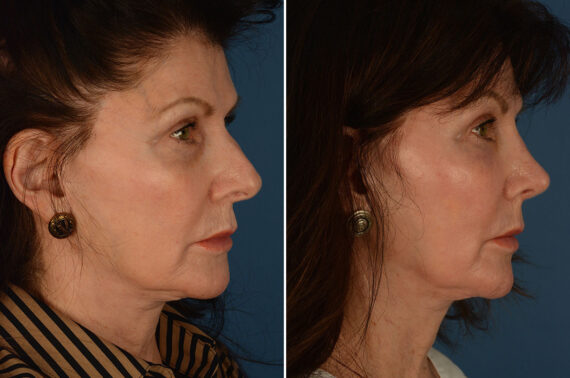 Rhinoplasty Before and After Photos in Naples, FL, Patient 25874