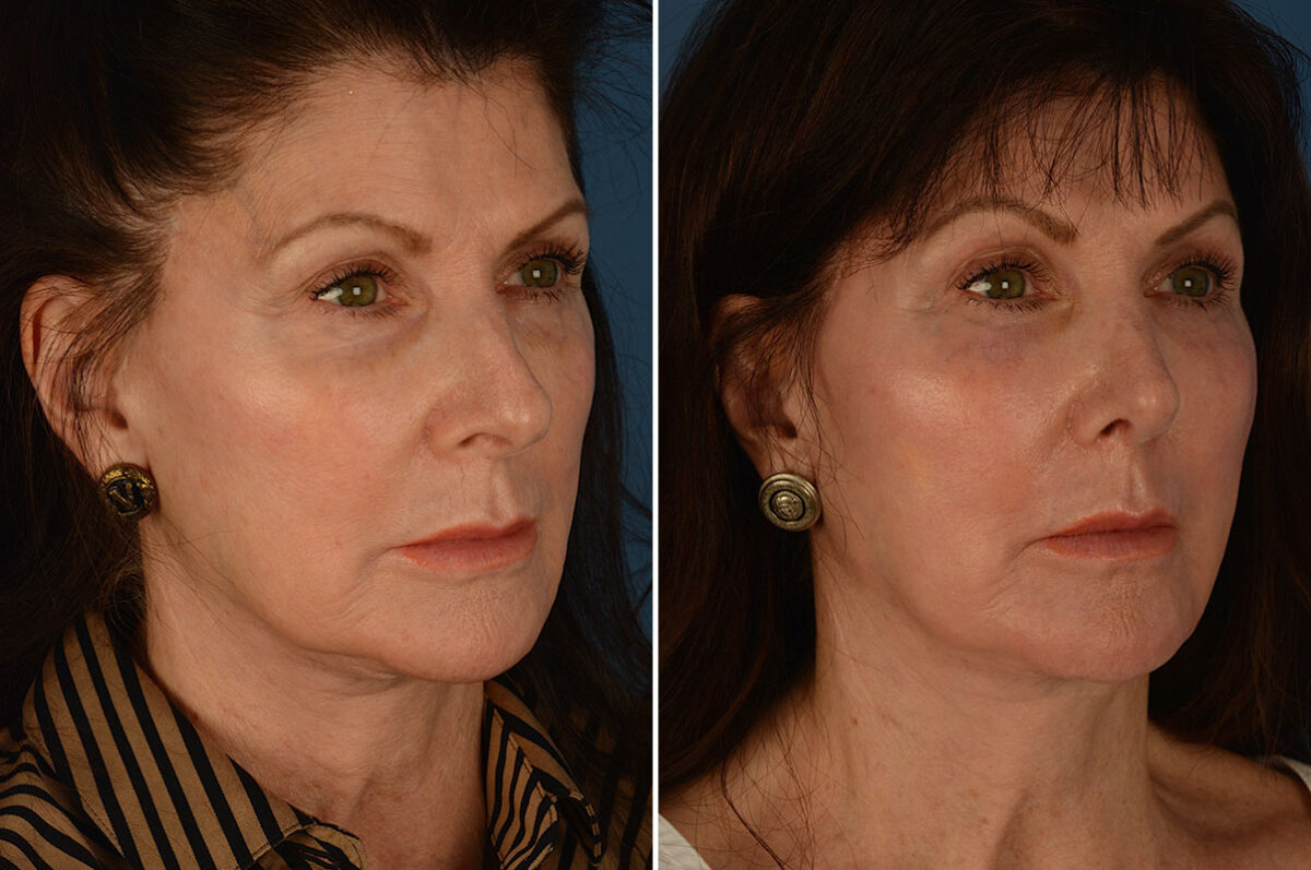 Rhinoplasty Before and After Photos in Naples, FL, Patient 25874