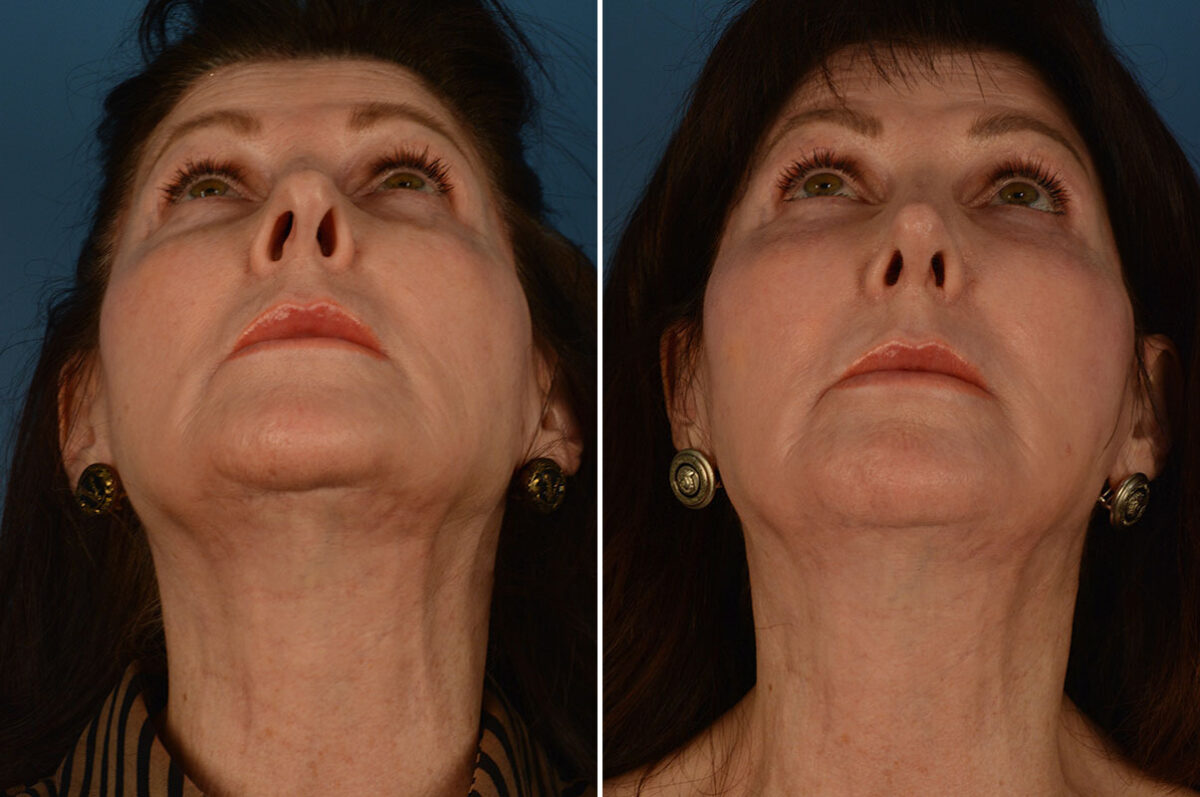 Rhinoplasty Before and After Photos in Naples, FL, Patient 25874