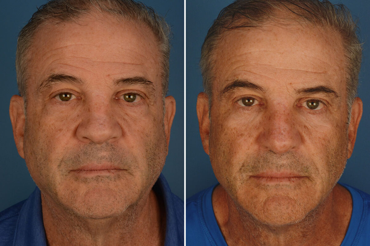 Revision Rhinoplasty Before and After Photos in Naples, FL, Patient 25939