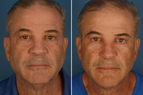 Revision Rhinoplasty Before and After Photos in Naples, FL, Patient 25939