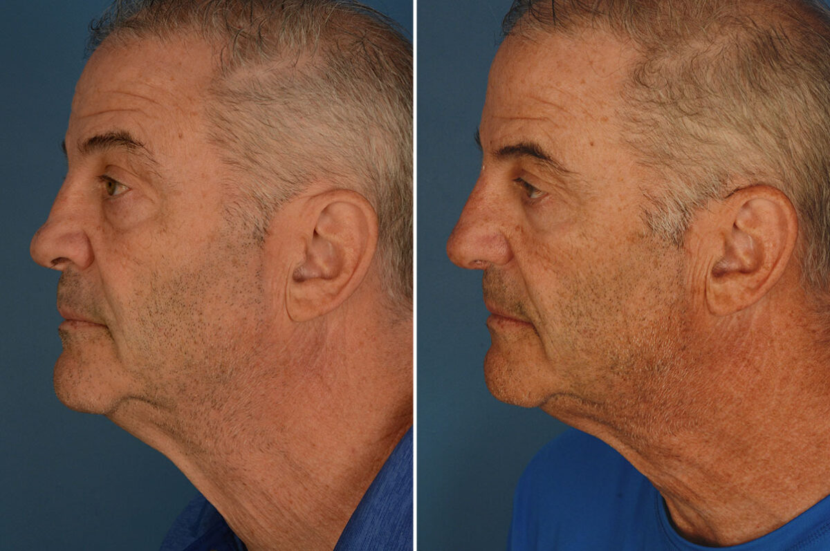 Revision Rhinoplasty Before and After Photos in Naples, FL, Patient 25939