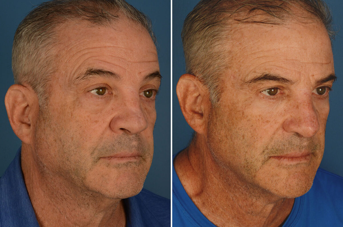 Revision Rhinoplasty Before and After Photos in Naples, FL, Patient 25939