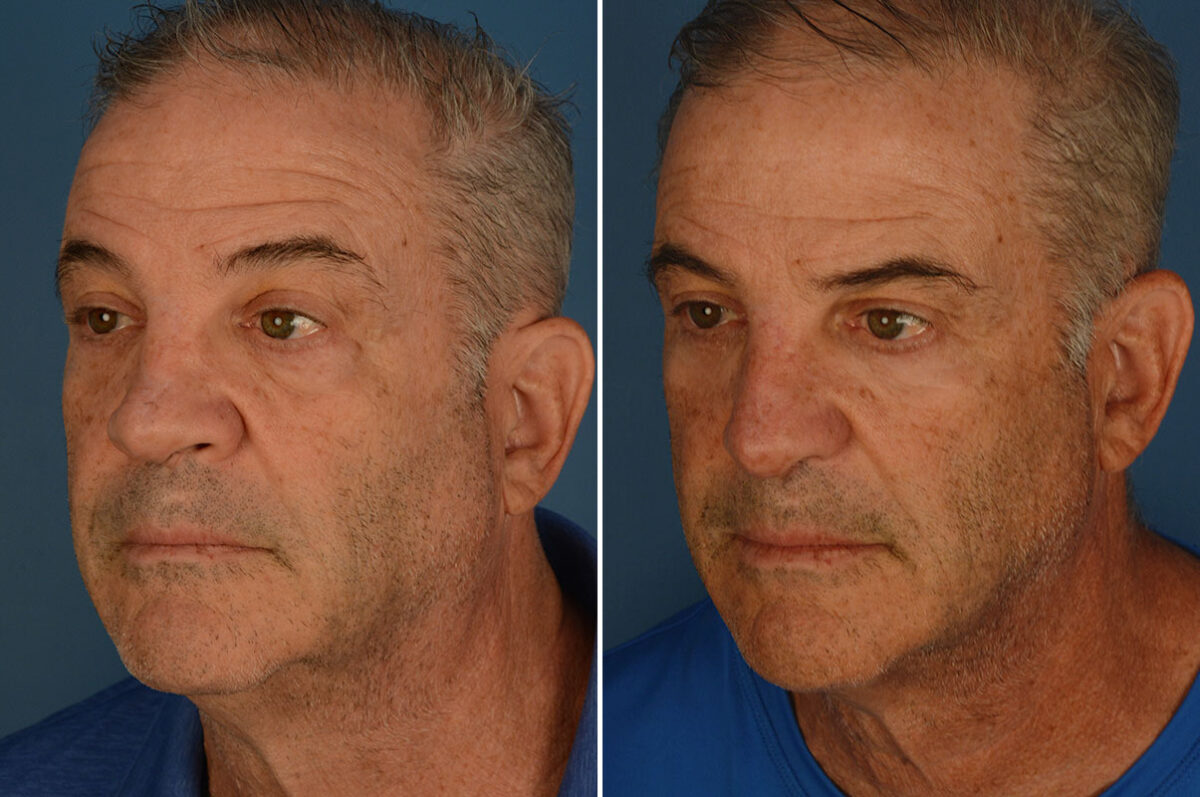 Revision Rhinoplasty Before and After Photos in Naples, FL, Patient 25939