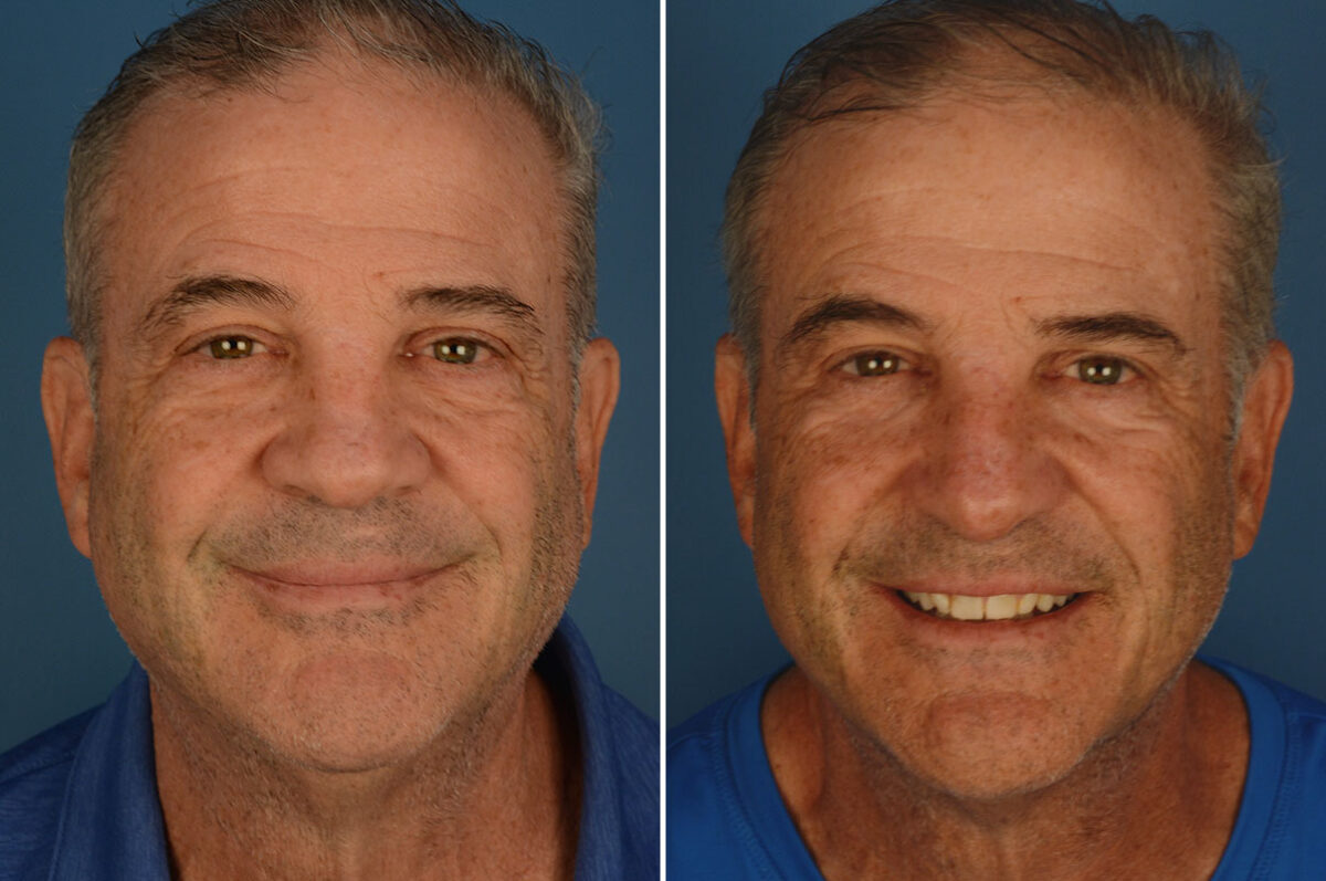Revision Rhinoplasty Before and After Photos in Naples, FL, Patient 25939