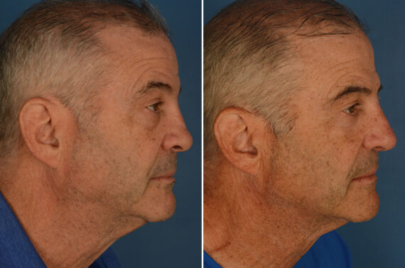 Revision Rhinoplasty Before and After Photos in Naples, FL, Patient 25939