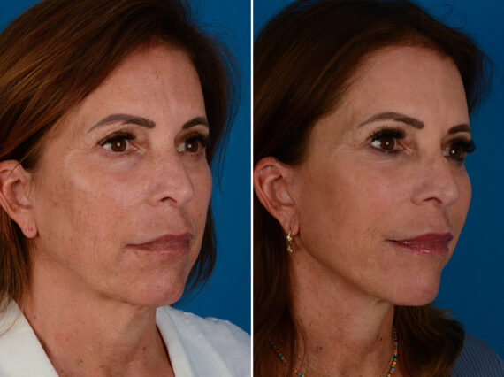 The UpLift™ Lower Face and Neck Lift Before and After Photos in Naples, FL, Patient 26037