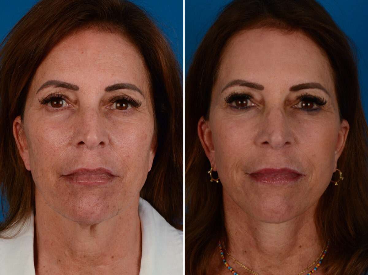 The UpLift™ Lower Face and Neck Lift Before and After Photos in Naples, FL, Patient 26037