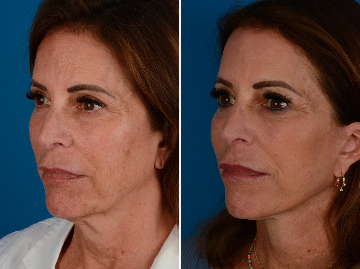 The UpLift™ Lower Face and Neck Lift Before and After Photos in Naples, FL, Patient 26037